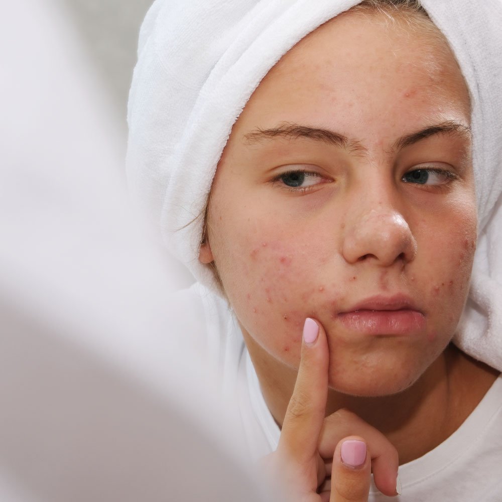 Acne Prone 2 Ein Pharm Online Shop -